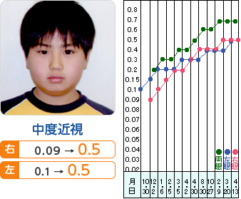 中度近視　右0.09→0.5　左0.1→0.5