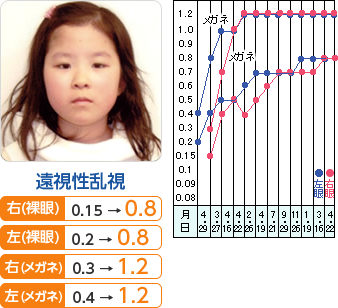 遠視性乱視　右（裸眼）： 0.15→0.8　左（裸眼）　： 0.2→0.8 右（メガネ）： 0.3→1.2 　左（メガネ）： 0.4→1.2