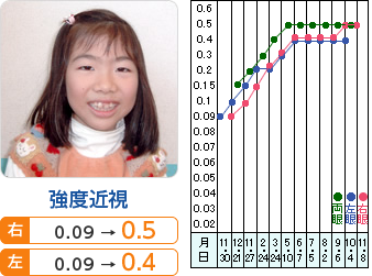 強度近視 右： 0.09→0.5 左： 0.09→0.4