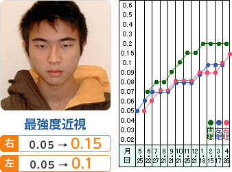 最強度近視　右： 0.05→0.15 左： 0.05→0.1