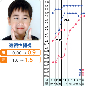 遠視性弱視　右： 0.06→0.9 左： 1.0→1.5